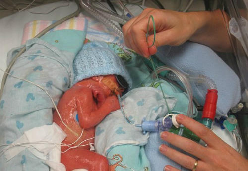 Cậu bé sinh non ngừng thở hồi sinh nhờ được cha mẹ ôm