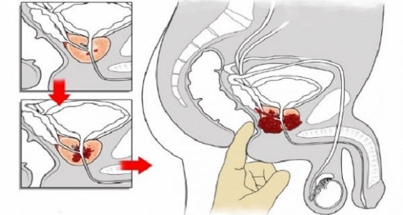 gừng và ung thư 0