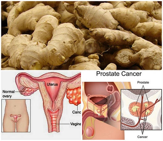 gừng và ung thư 0