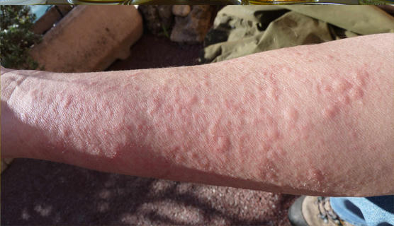 độc tố nhiều 0