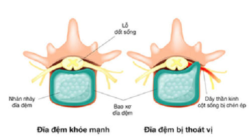Thoát vị đĩa đệm là do vận động quá mức hoặc có thể do đĩa đệm yếu đi theo tuổi tác dẫn đến chấn thương đĩa gây ra đau đớn