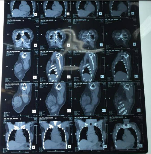 Kết quả CT Scan.
