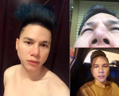 Hoàng Tôn công khai chia sẻ về biến chứng mà anh gặp phải sau khi phẫu thuật mũi và cằm.