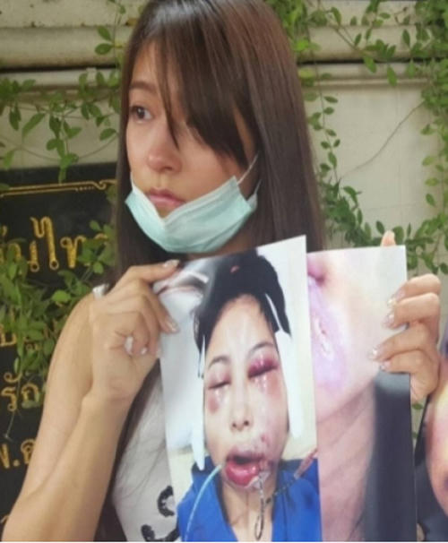 Người mẫu Thái Lan công khai khuôn mặt biến dạng sau phẫu thuật thẩm mỹ để cảnh báo những cô gái trẻ suy nghĩ kỹ trước khi quyết định đụng dao kéo.