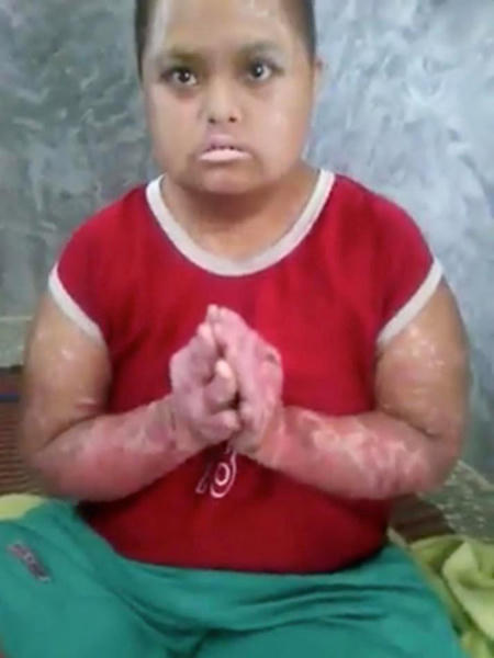  Momo với thân hình sưng phù, da đỏ tấy. Ảnh: ExclusivPix 