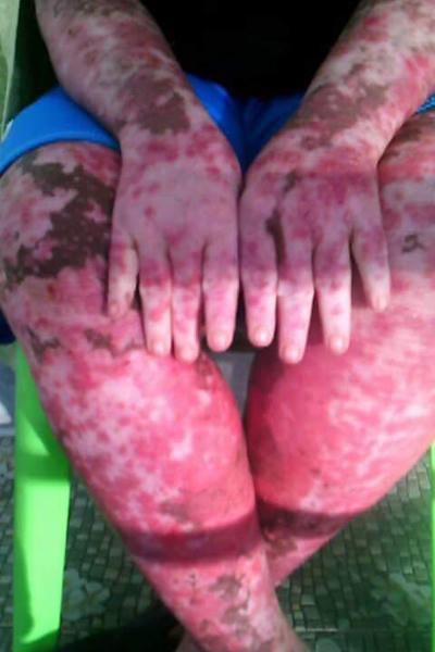  Tay chân cô bé đỏ tấy nghiêm trọng. Ảnh: ExclusivPix 