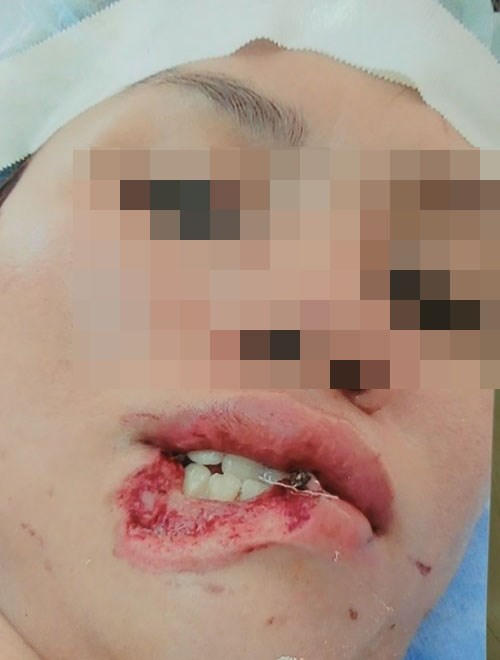 Cô ruột cắn cháu gái đứt lìa 1/3 môi - ảnh 1