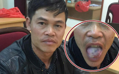 co gai can gan dut luoi yeu rau xanh co bi xu ly hanh vi gay thuong tich hinh 1