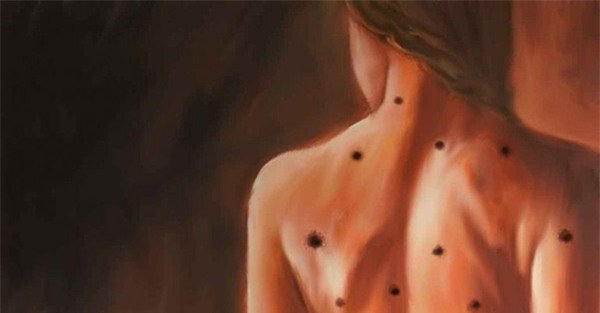 nốt ruồi, dấu hiệu ung thư, ung thư, ung thư da, cảnh báo ung thư