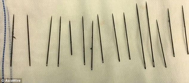 bac-si-toat-mo-hoi-khi-mo-gap-15-cay-kim-cho-quy-ong-thich-tu-suong-1