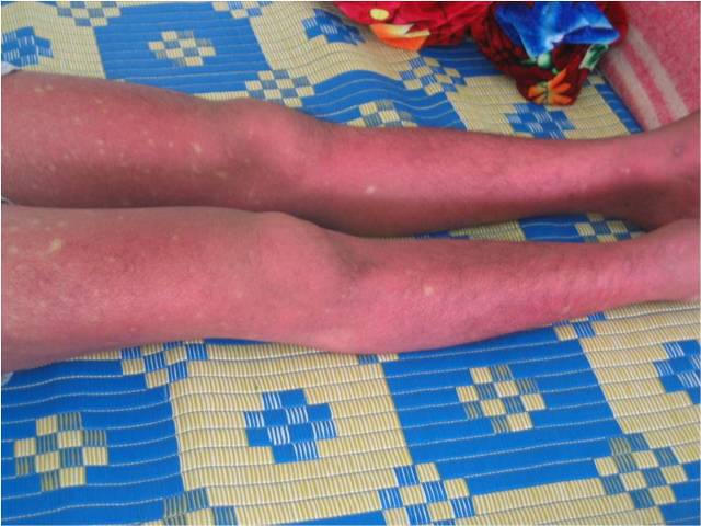 Những dấu hiệu cảnh báo nguy hiểm của Sốt xuất huyết