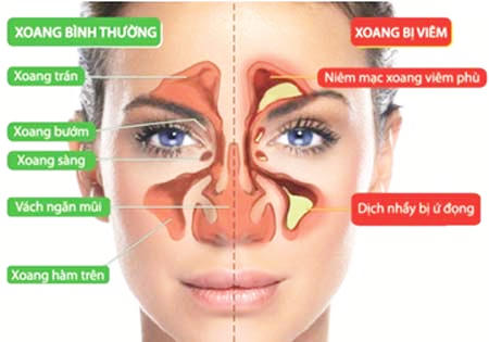 Cách đơn giản tự chữa viêm xoang