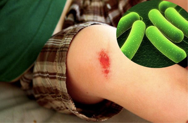 uốn ván, bệnh uốn ván, nhiễm trùng uốn ván, bệnh uốn ván, nhiễm trùng