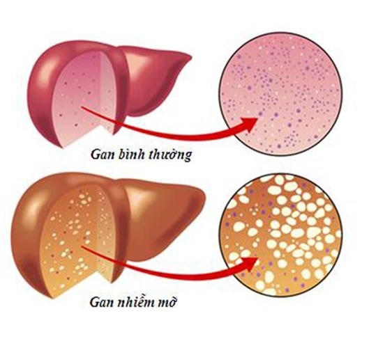 gan nhiễm mỡ,Dấu hiệu gan nhiễm mỡ