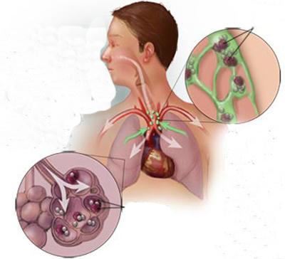 Ẩm ướt, coi chừng bệnh nấm phổi
