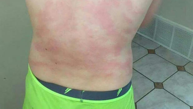 dị ứng,nổi mề đay,bệnh lạ,bệnh hiếm