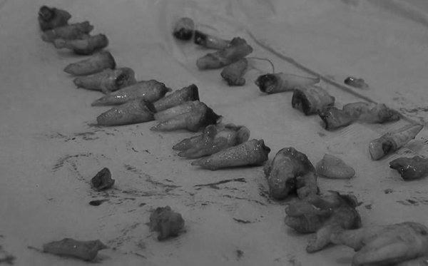 sâu răng,nước ngọt có ga,răng giả