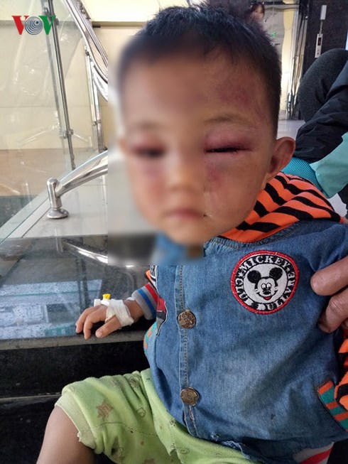 lam ro vu viec be trai 2 tuoi nghi bi cha duong bao hanh den nhap vien hinh 1