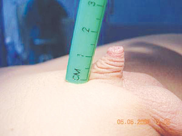 Vùi dương vật, lời nguyền và phục sinh…