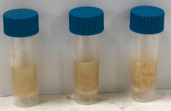 Dịch màng phổi dẫn lưu và xét nghiệm của bệnh nhi đầy mủ. Ảnh bệnh viện cung cấp.