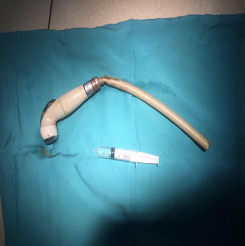 Bác sĩ "choáng" với dị vật khủng trong hậu môn nam thanh niên