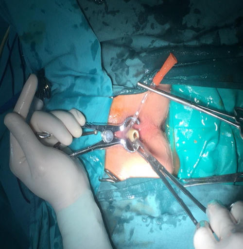 Bác sĩ "choáng" với dị vật khủng trong hậu môn nam thanh niên