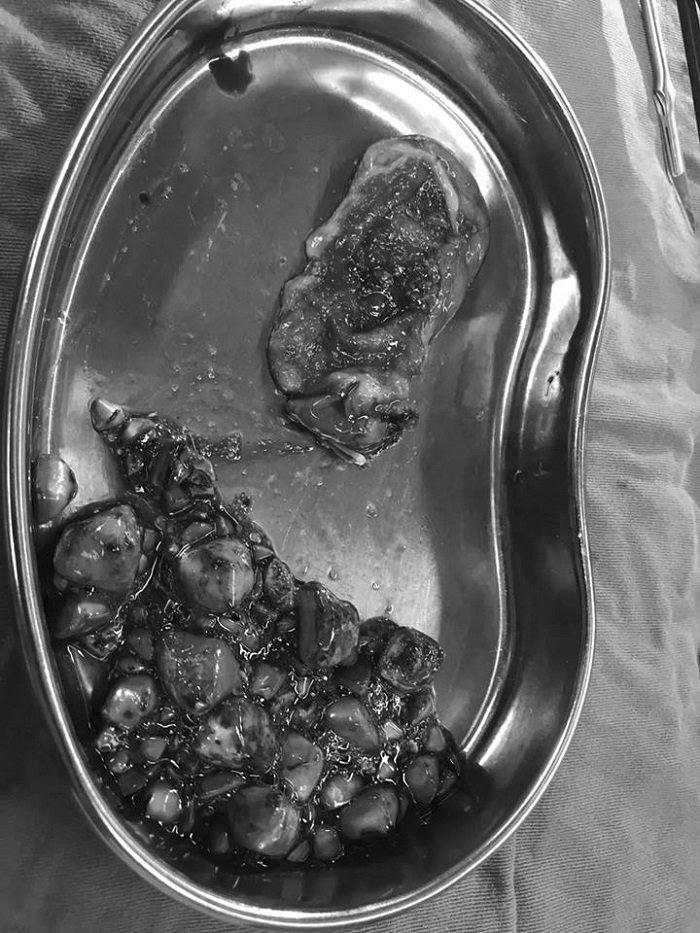 Cô gái 20 tuổi bị 100 viên sỏi mật, vì hay ăn món hàng triệu người vẫn thích