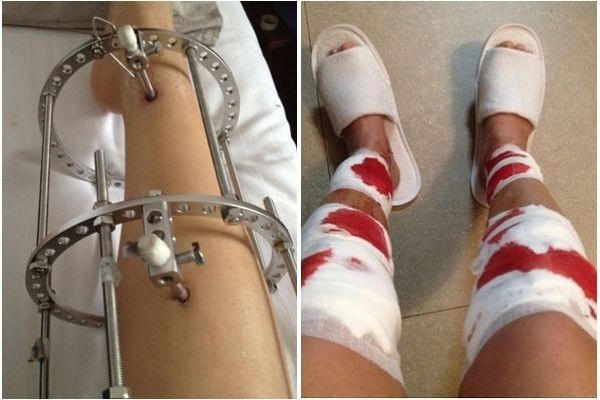 Những kiểu phẫu thuật thẩm mỹ nguy hiểm không nên áp dụng