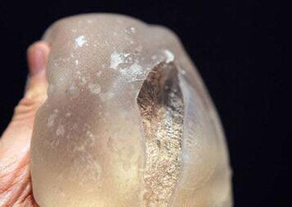 Người mẹ 28 tuổi bị nổ túi ngực 170 triệu khi cho con bú