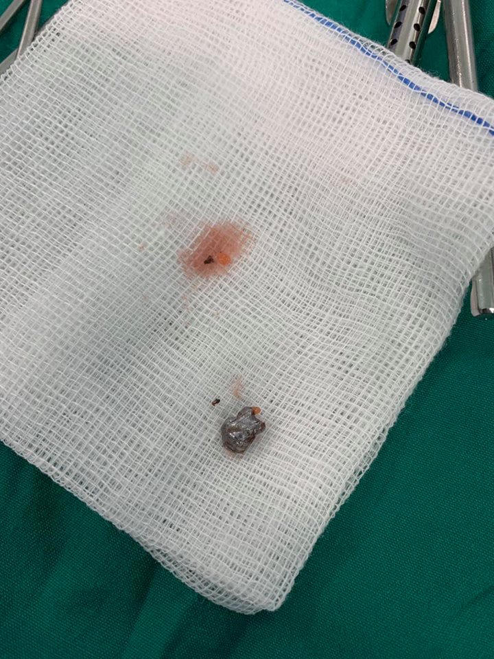 Anh 9 tuổi nghịch súng cướp cò bắn xuyên cổ em trai 6 tuổi hình ảnh 4 anh 9 tuoi nghich sung cuop co ban xuyen co em trai 6 tuoi hinh anh 4