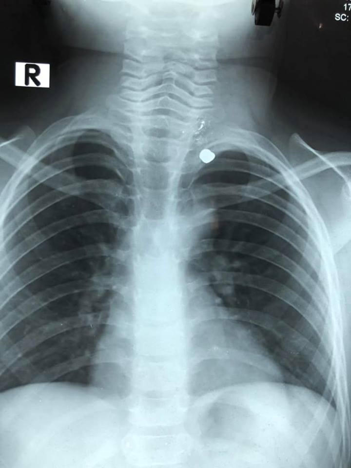 Anh 9 tuổi nghịch súng cướp cò bắn xuyên cổ em trai 6 tuổi hình ảnh 2 anh 9 tuoi nghich sung cuop co ban xuyen co em trai 6 tuoi hinh anh 2