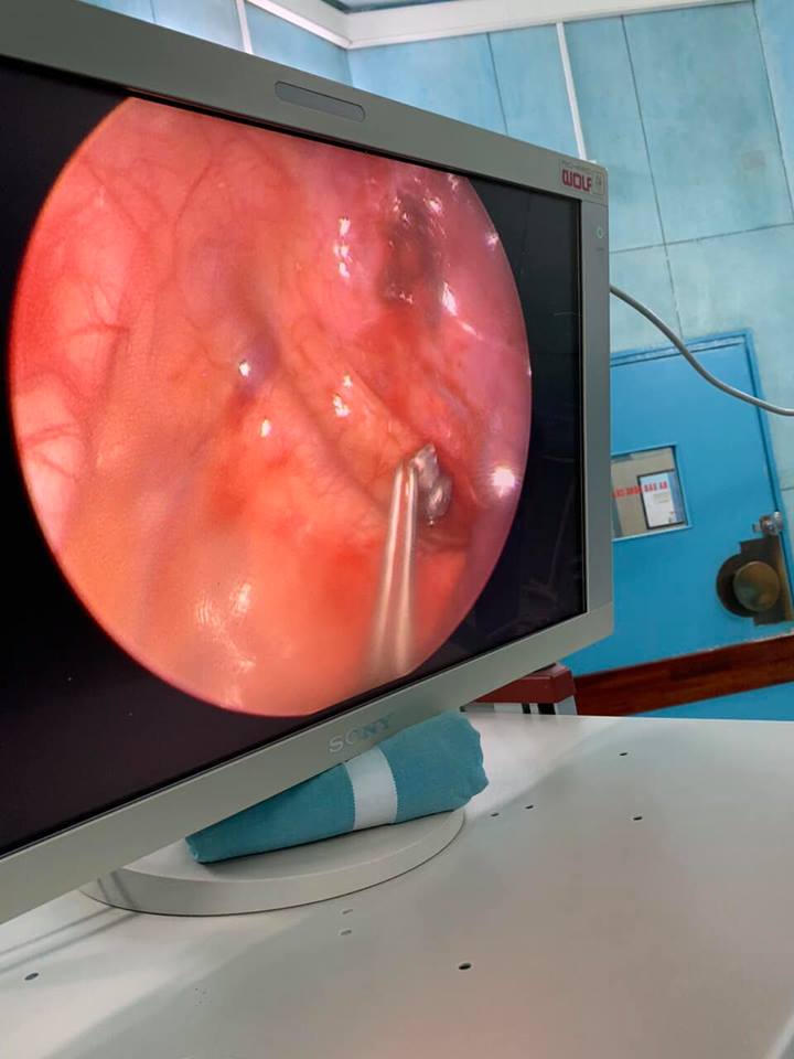 Anh 9 tuổi nghịch súng cướp cò bắn xuyên cổ em trai 6 tuổi hình ảnh 3 anh 9 tuoi nghich sung cuop co ban xuyen co em trai 6 tuoi hinh anh 3