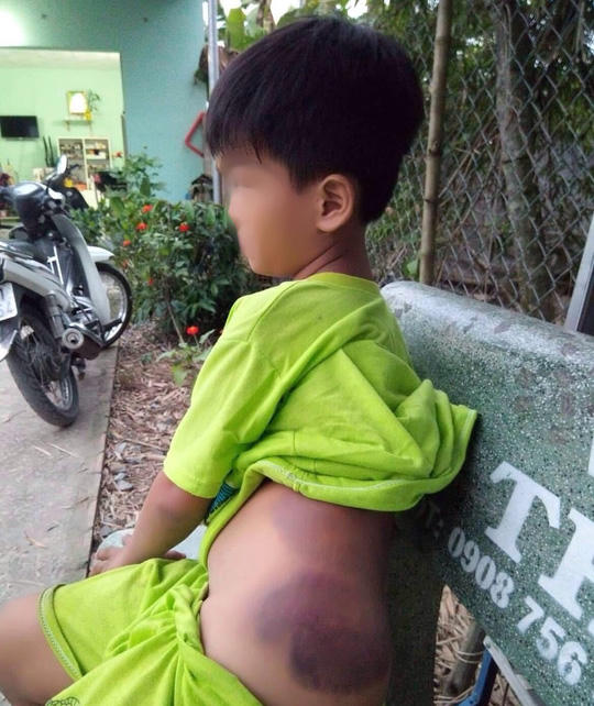 Sốc: Một học sinh khuyết tật bị cô giáo đánh bầm tím cơ thể