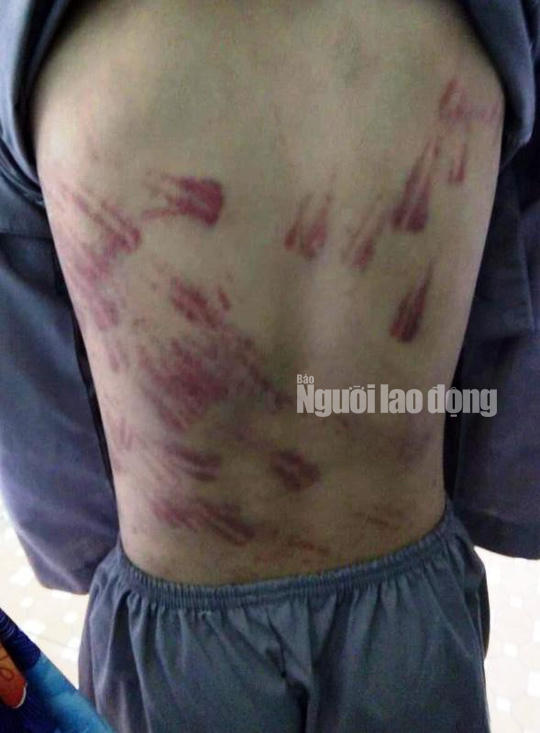 Bé trai 10 tuổi bị sư thầy bạo hành thâm tím khắp người