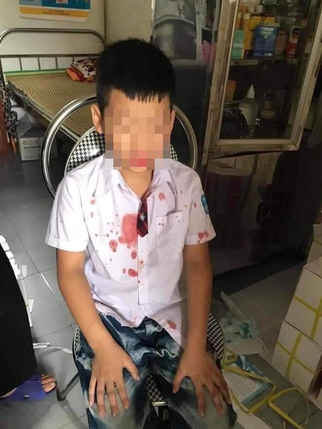 Mâu thuẫn vụ học sinh lớp 1 bị bố của bạn đánh đến nhập viện