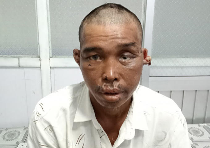 Vụ ngư dân Cà Mau bị hành hạ trên biển: Một nạn nhân được xác định thương tích 48%