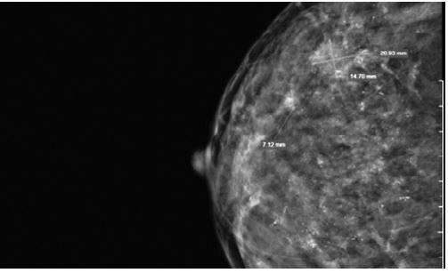 Chủ quan khối u vú, người phụ nữ ngỡ ngàng phát hiện ung thư vú thể lan tỏa hiếm gặp