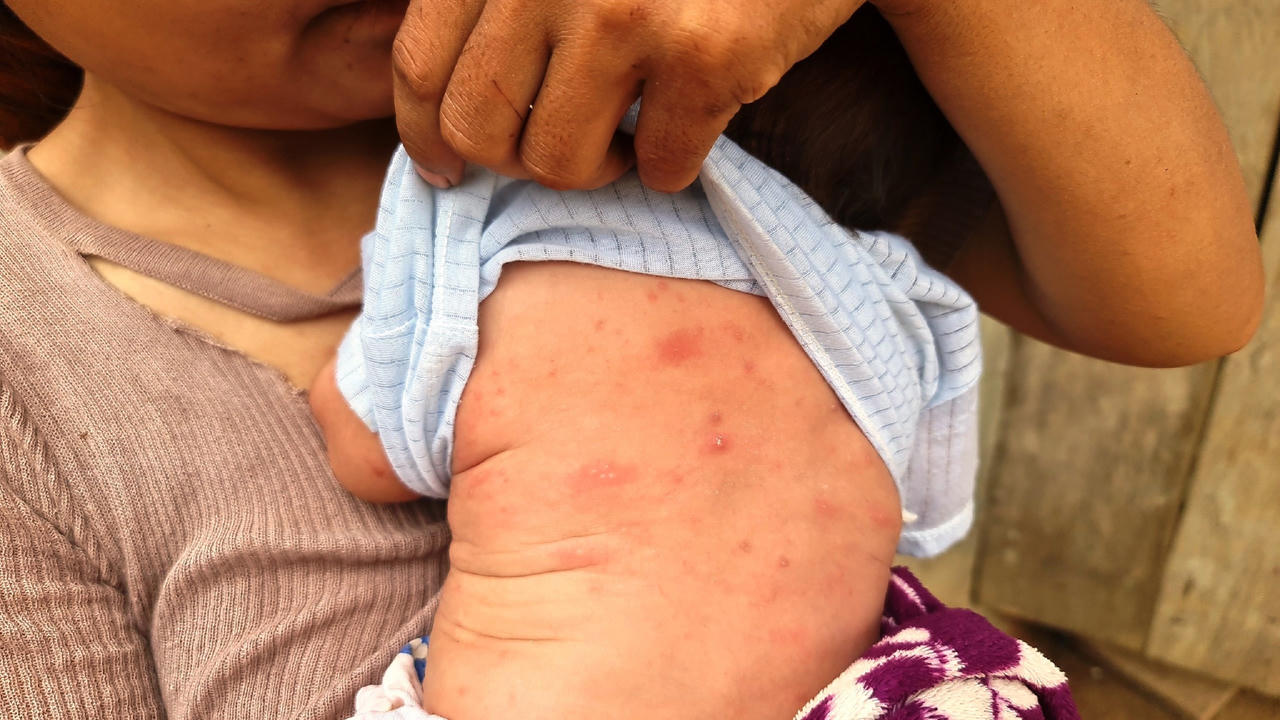 Bệnh ghẻ “tấn công” một số ngôi làng vùng cao Quảng Ngãi