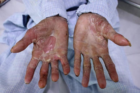 Bệnh nhân cô đơn không người thân, không một xu dính túi