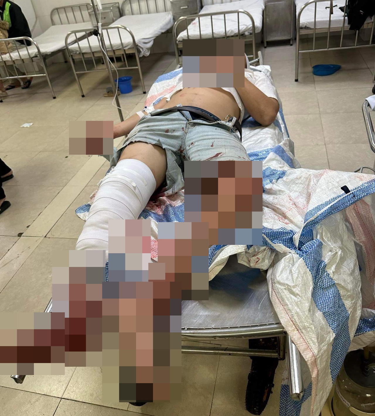 Bình Định: Hai anh em ruột nhập viện cấp cứu vì bị đánh hội đồng