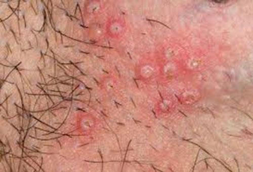 Kết quả hình ảnh cho khắc phuc ngứa vùng kín