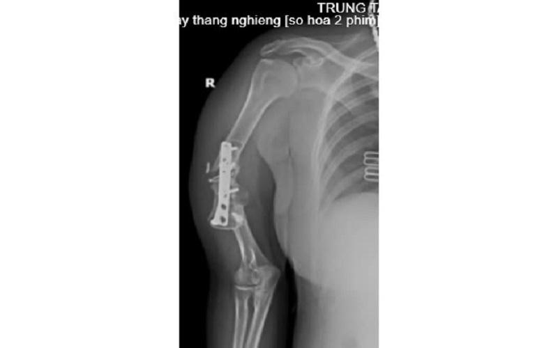 Phú Thọ: Trung tâm Y tế huyện Cẩm Khê phẫu thuật thành công ca ghép xương điều trị khớp giả