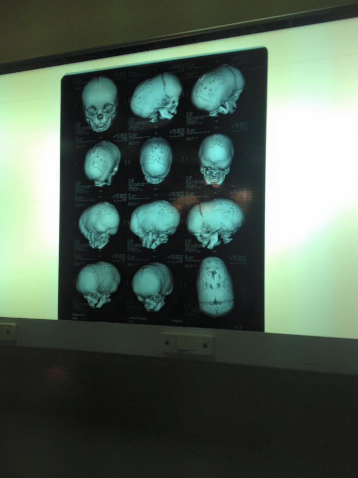 Bệnh viện Xanh Pôn phẫu thuật thành công hộp sọ biến dạng hình thuyền