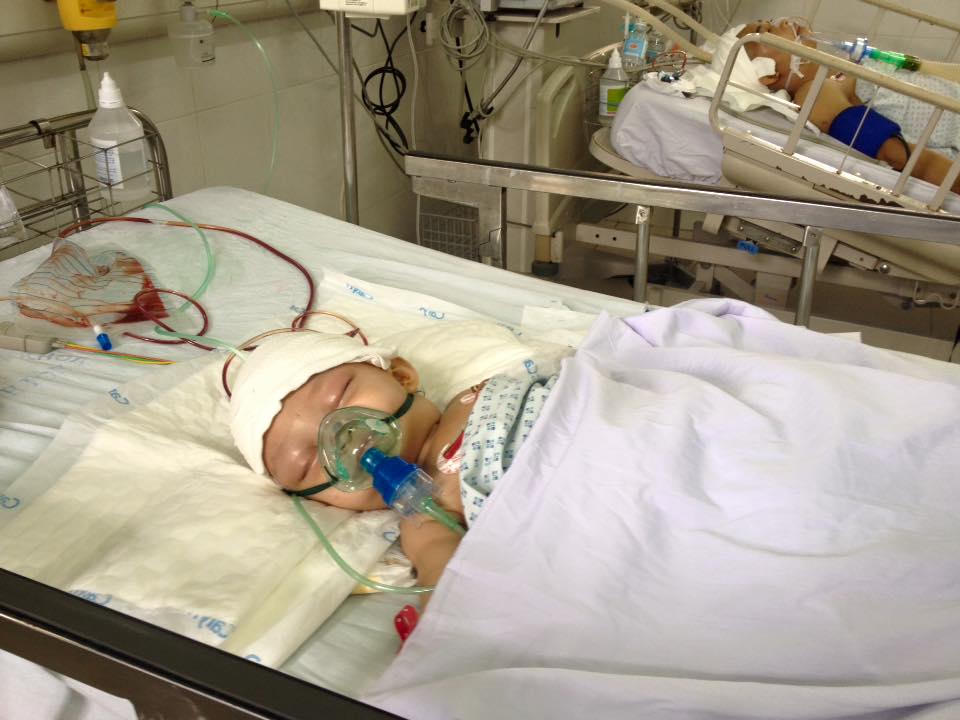 Bệnh viện Xanh Pôn phẫu thuật thành công hộp sọ biến dạng hình thuyền