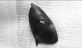 Hóc dị vật ở người lớn: Lời khuyên của bác sĩ điều trị