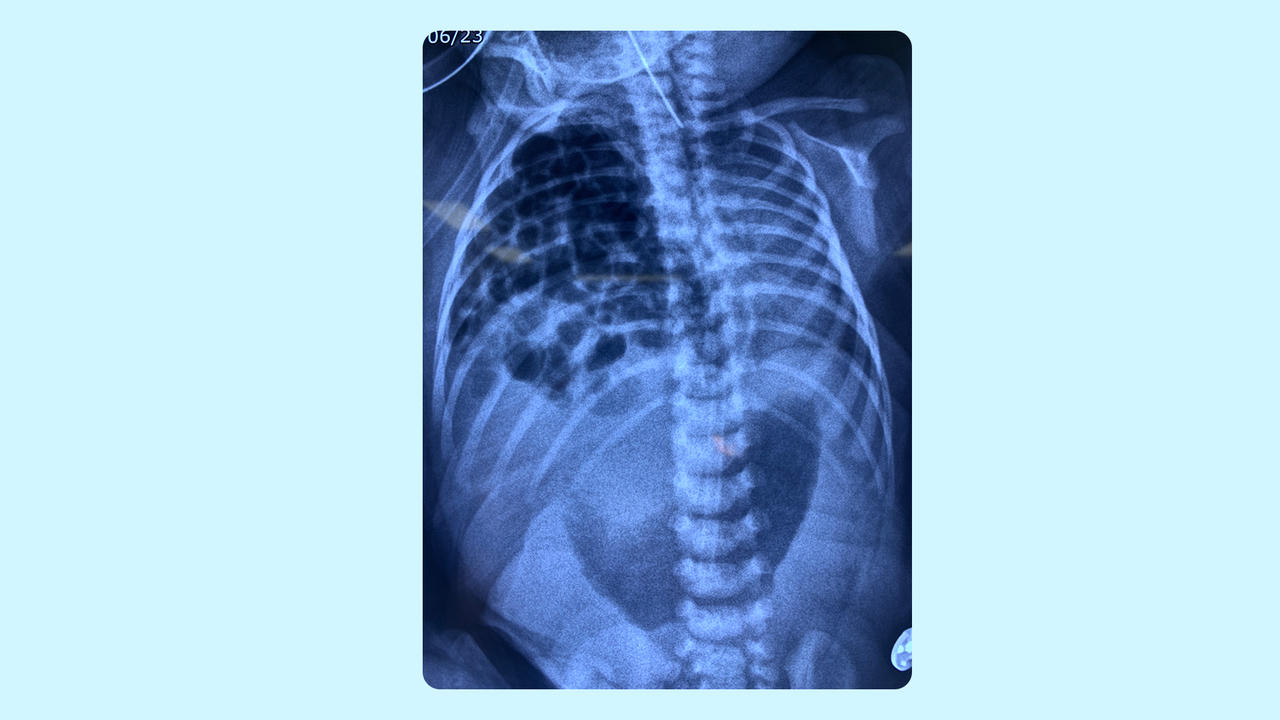 Bệnh viện Tâm Anh cứu trẻ 4 ngày tuổi mắc dị tật bẩm sinh hiếm gặp