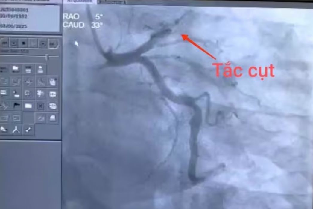 Hút 2 bao thuốc lá mỗi ngày, người đàn ông 43 tuổi suýt mất mạng