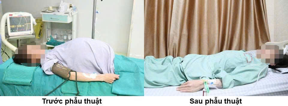 Người phụ nữ mang khối u khổng lồ 15kg được phẫu thuật thành công