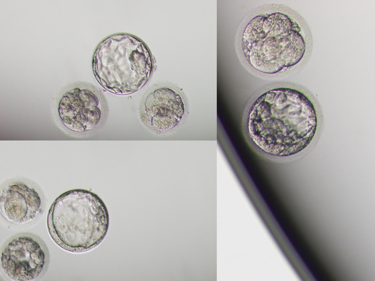 Bệnh viện Sản nhi Phú Thọ thành công vi phẫu thuật Micro Tese trong điều trị vô sinh nam