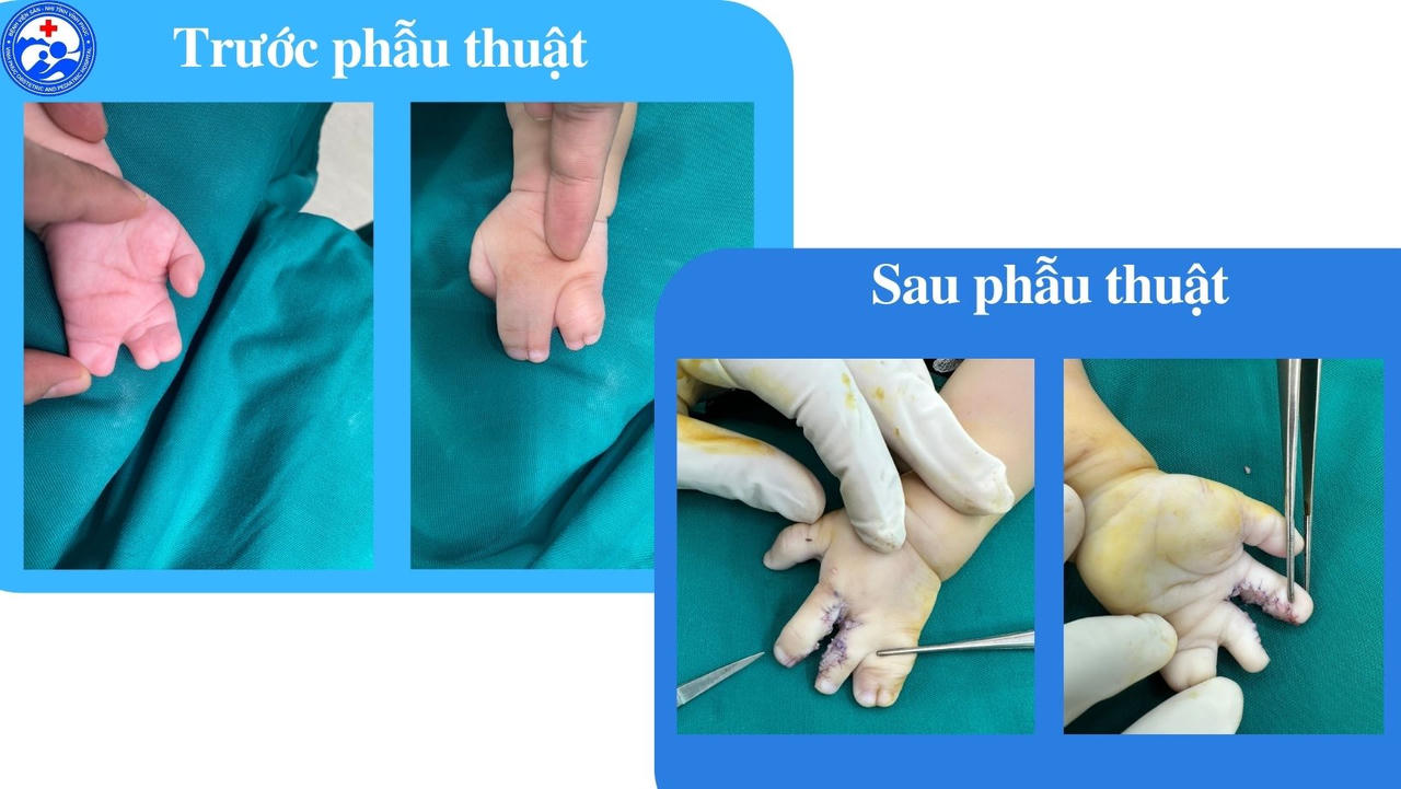 Bệnh viện Sản Nhi tỉnh Vĩnh Phúc phẫu thuật thành công cho bệnh nhi dính ngón tay bẩm sinh